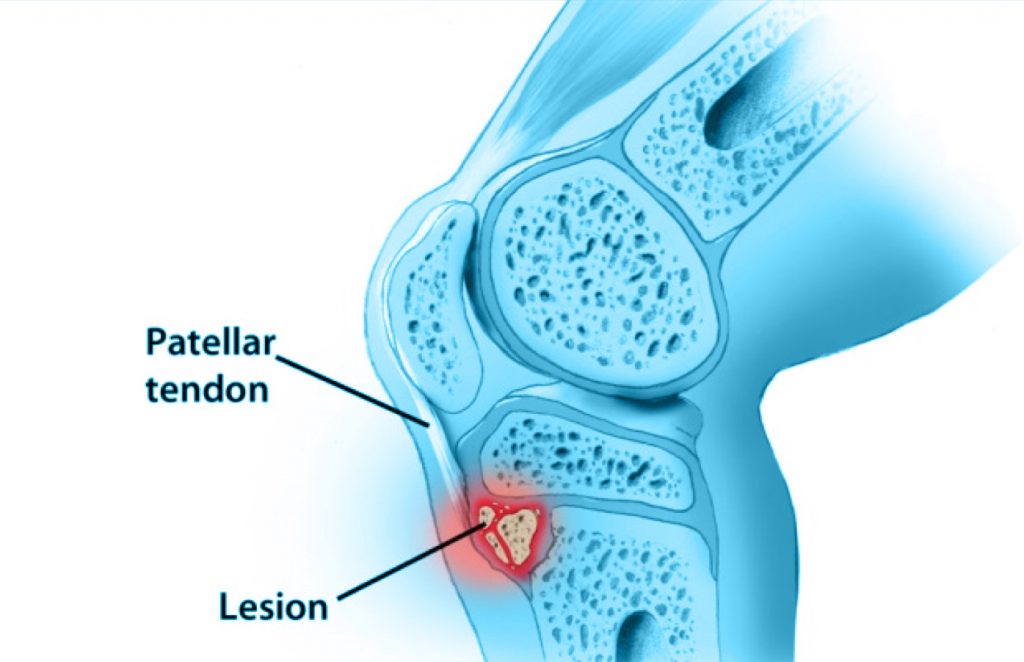 Dr. Carlos Godoy Enfermedad de OsgoodSchlatter