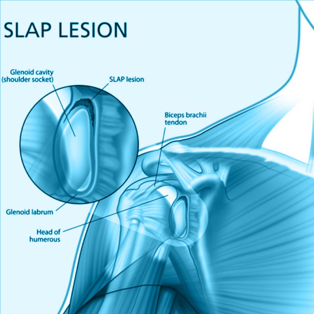 Dr. Carlos Godoy Lesiones tipo SLAP (Superior Labrum AnteriorPosterior)
