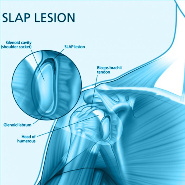 Dr. Carlos Godoy Lesiones tipo SLAP (Superior Labrum AnteriorPosterior)