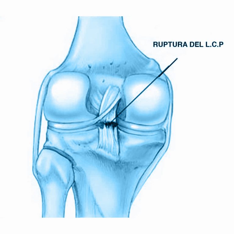 Dr. Carlos Godoy Ligamento Cruzado Posterior Dr. Carlos Godoy Ligamento Cruzado Posterior